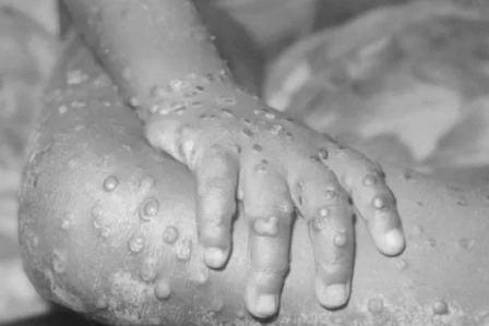 تسجيل أول حالة جدري القرود في 